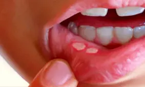 درمان آفت دهانی با روش ساده خانگی