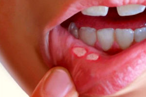 درمان آفت دهانی با روش ساده خانگی