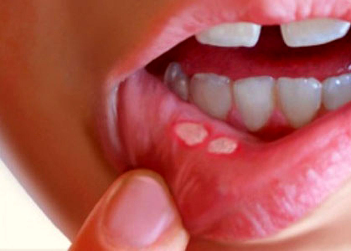 درمان آفت دهانی با روش ساده خانگی