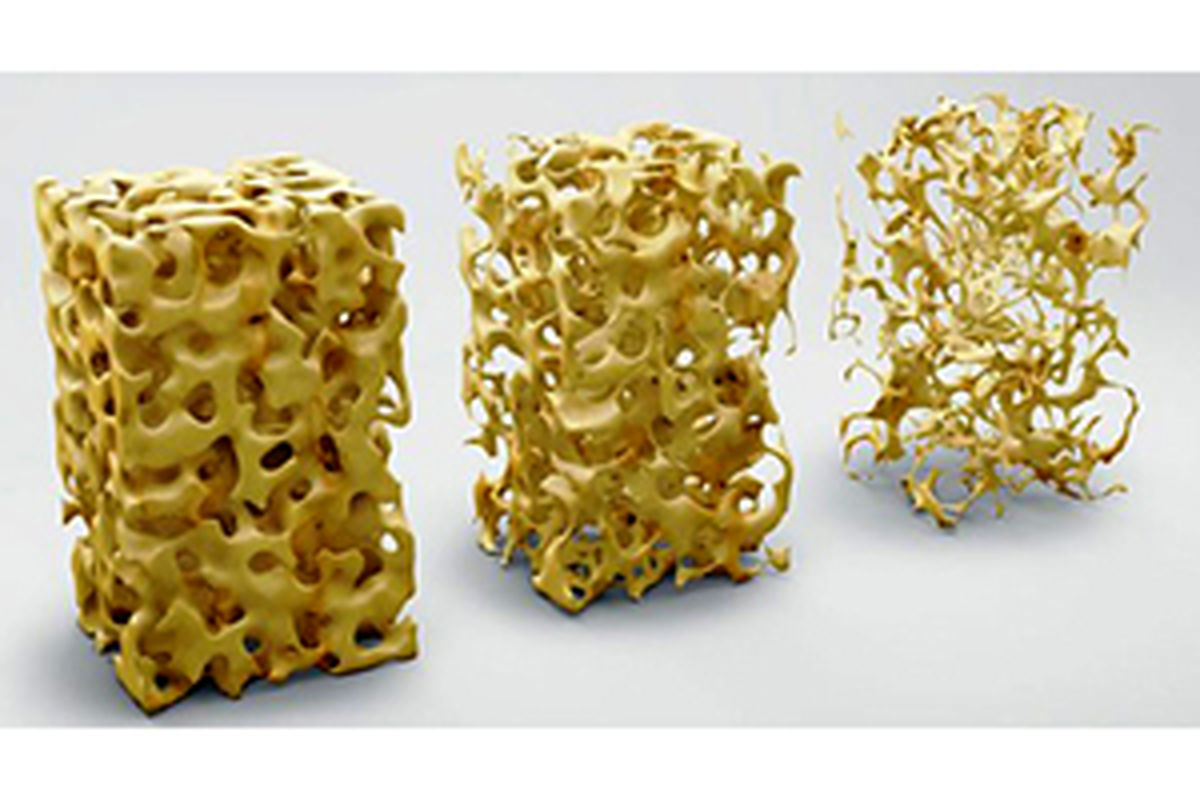 عوامل موثر بر پوکی استخوان که کمی عجیب به نظر می رسند