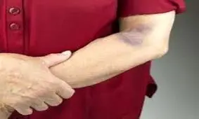 کبودی های خطرناک بدن را بشناسید