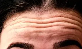 هشدارهای تغذیه در مورد چین و چروک‌های پوستی