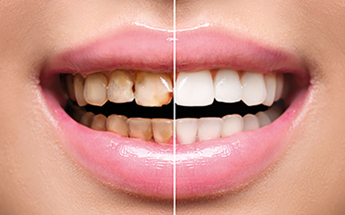پوسیدگی دندان چرا و چگونه اتفاق می افتد؟