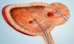 خبر شیوع بیماری سرطان مثانه به دلیل آلودگی آب کارون غیرواقعی است