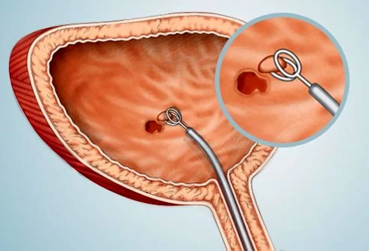 خبر شیوع بیماری سرطان مثانه به دلیل آلودگی آب کارون غیرواقعی است