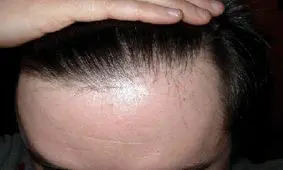 چرا مو‌های ما نازک می‌شوند؟