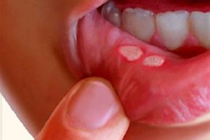 آفت دهان چیست؟ +علل و راه‌های درمان آن
