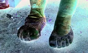 عجیب‌ترین و نادرترین بیماری‌های تاریخ/ از انفجار سر تا آلیس در سرزمین عجایب!