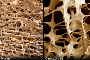 دلیل ایجاد پوکی استخوان + تشخیص + راههای مختلف درمان