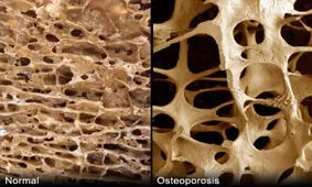 دلیل ایجاد پوکی استخوان + تشخیص + راههای مختلف درمان