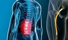 سیاتیک چیست و چگونه درمان می‌شود؟