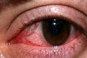 ویزیت رایگان چشم بیش از هزار بیمار/«گلوکوم»، خطرناک‌ترین بیماری خاموش چشم