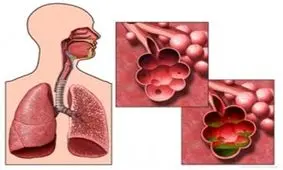 ۳ نشانه که زنگ خطر بیماری‌های ریوی را به صدا در می‌آورند!