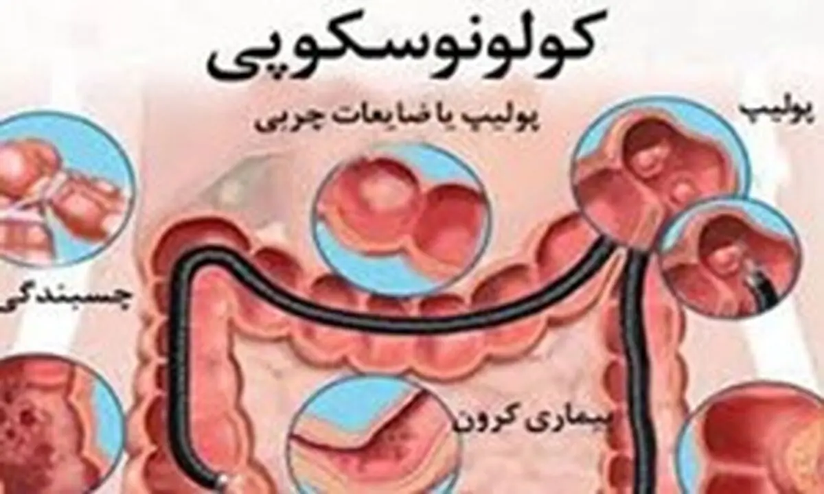 انجام کولونوسکوپی برای چه کسانی ضرورت دارد؟