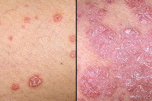 این دو بیماری پوستی را چگونه از هم تشخیص بدهیم؟