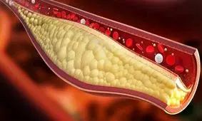 چطور بفهمیم چربی خون مان بالاست؟