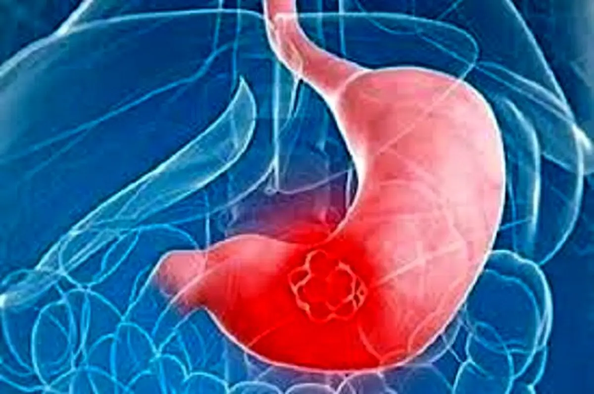 مصرف سیگار دلیل عمده ایجاد زخم معده