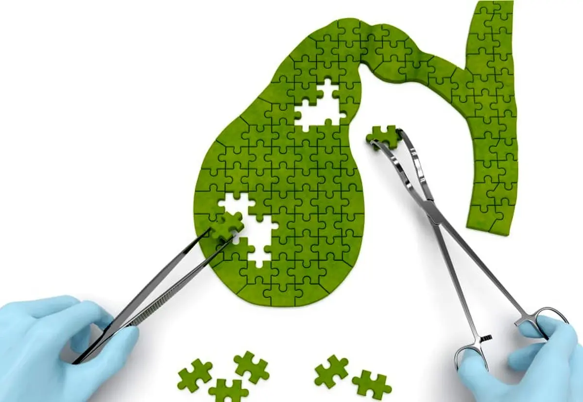 زندگی بدون کیسه صفرا