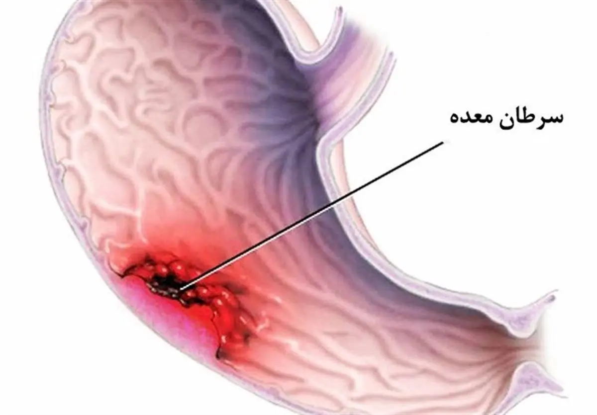 تغذیه مناسب را جدی بگیرید تا سرطان نگیرید / ۶ غذایی که نباید بخورید