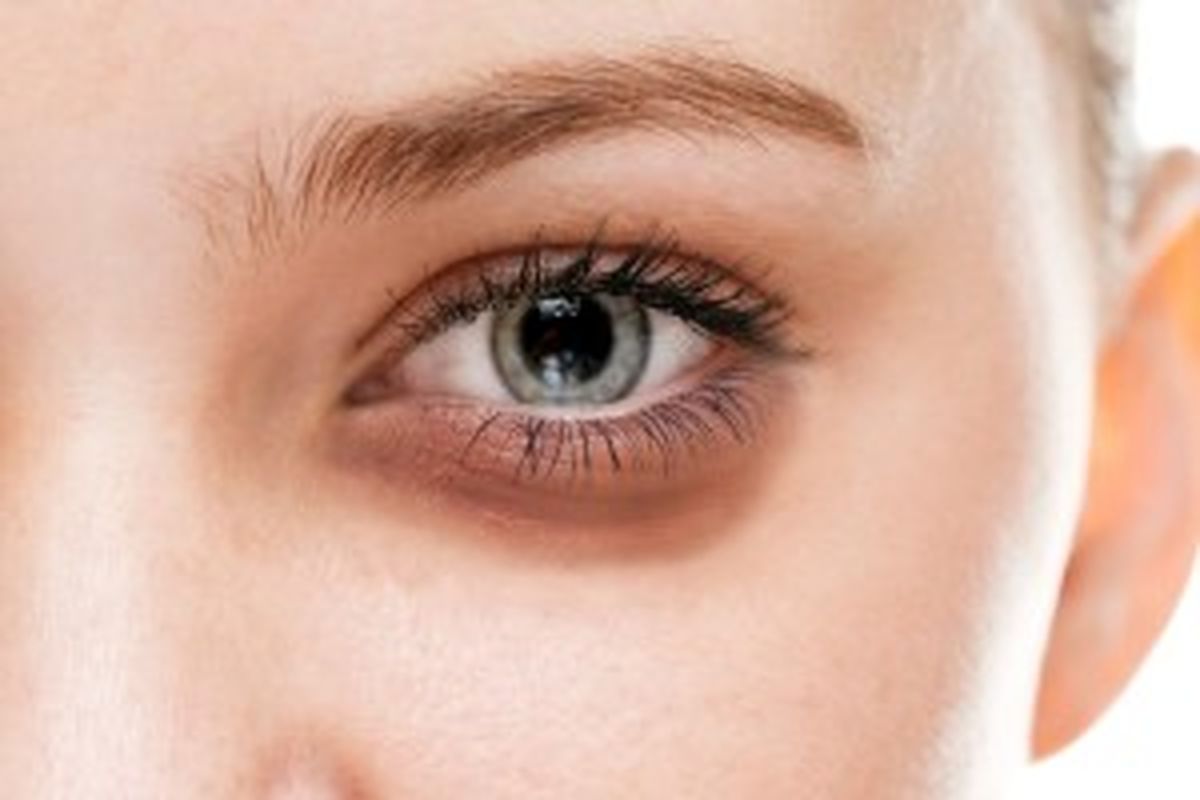 از بین بردن پف زیر چشم با چند راهکار ساده