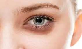 از بین بردن پف زیر چشم با چند راهکار ساده