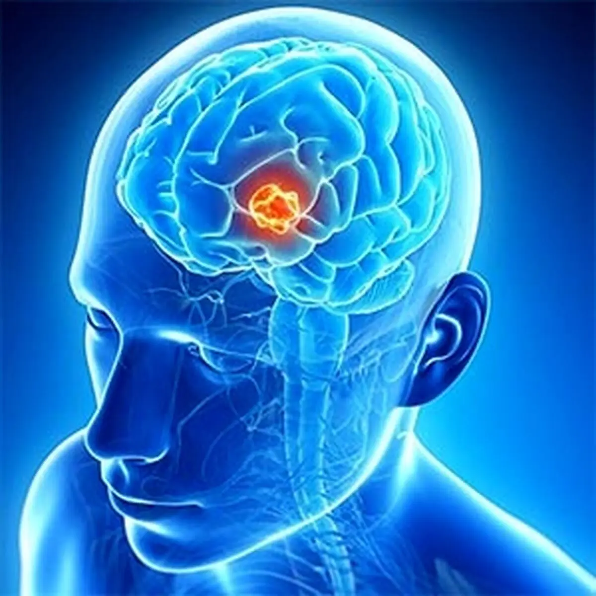 تنبلی چشم یا "آمبلوپی" چیست و چه تاثیری بر رشد مغز دارد؟