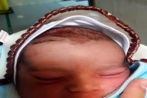 تیغ جراحی پیشانی نوزاد سزارینی را شکافت