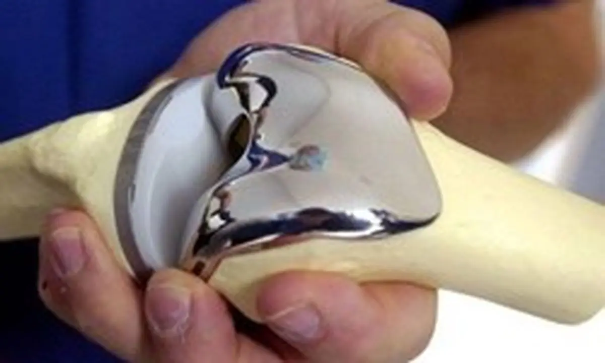 کمبود پروتز مفصل در کشور/نیاز به جراحی در بیماران گرفتار آرتروز شدید