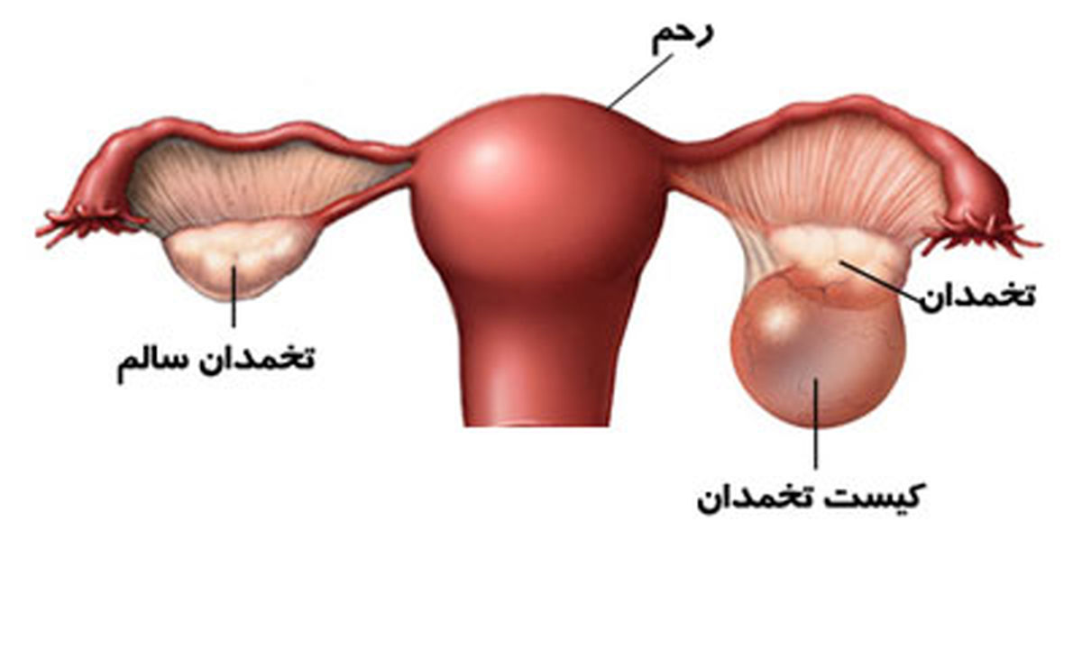 کیست های شایع و ترسناک دختران جوان