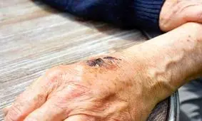 راهکاری جدید برای جلوگیری از عفونت زخم