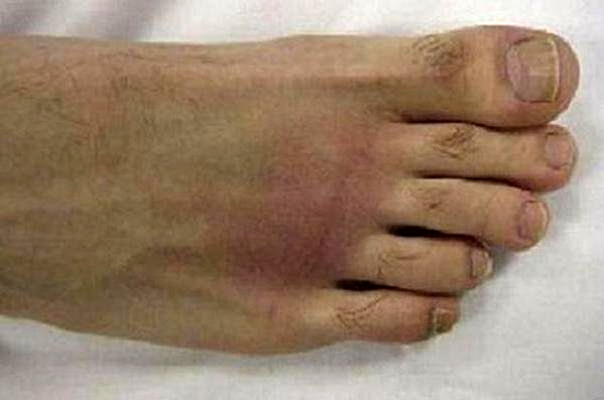 ۵ علامت آرتروز پا را بشناسید