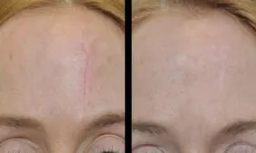 از بین بردن جای بخیه و زخم با عصاره پیاز