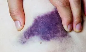 بدن ما چرا بی دلیل کبود می شود؟