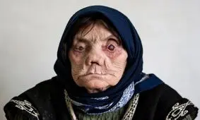 وضعیت شیوع جذام در ایران؛ شناسایی ۹ مبتلای جدید

