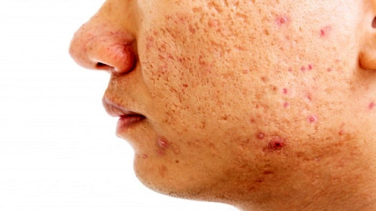جای جوش با لیزر کاملا رفع میشود؟