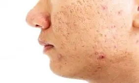 جای جوش با لیزر کاملا رفع می‌شود؟