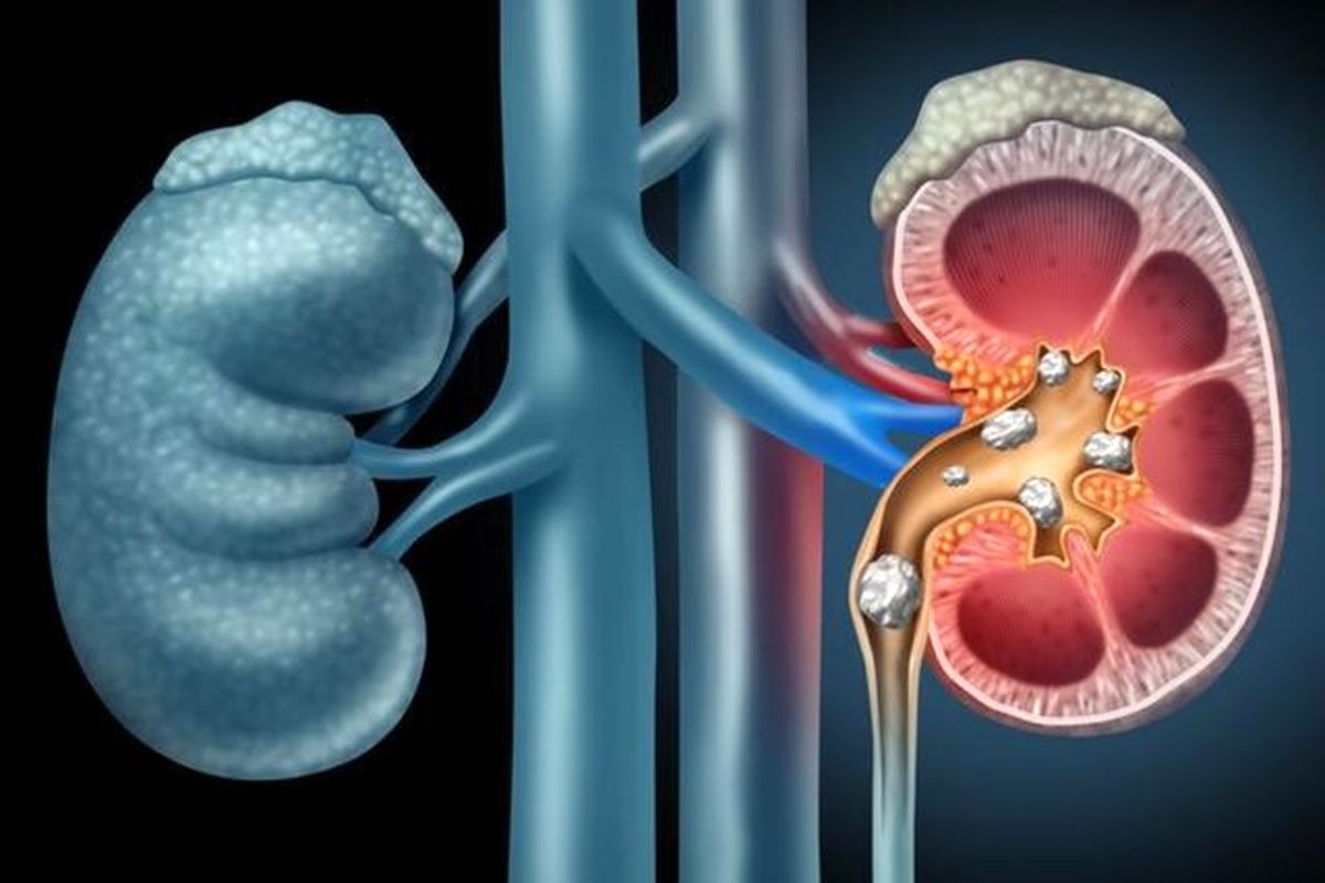 چگونه میتوان از ابتلا به سنگ کلیه پیشگیری کرد؟