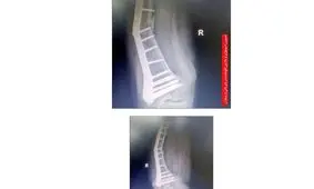 جنجال پلاتین های کج شده در بدن بیماران بیمارستانی در نیشابور / پشت پرده شرکت تولید پلاتین چیست؟