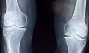 امید تازه برای درمان آرتروز
