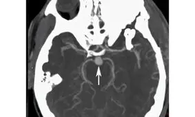 «آنوریسم مغزی» چیست؟
