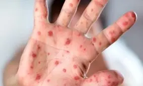 شناسایی ۷۰ بیمار مبتلا به سرخک در هرمزگان