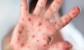 شناسایی ۷۰ بیمار مبتلا به سرخک در هرمزگان