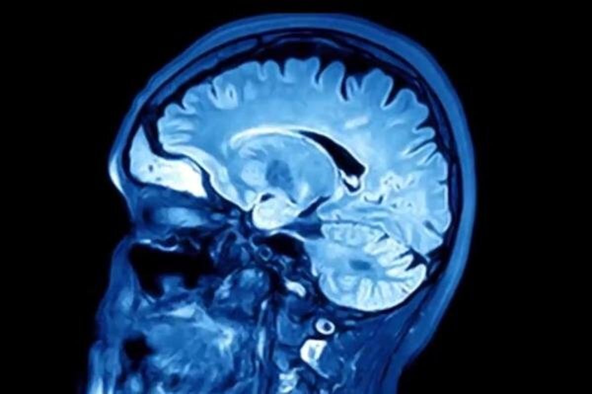 آهسته راه رفتن نشانه ابتلا به زوال عقل است؟