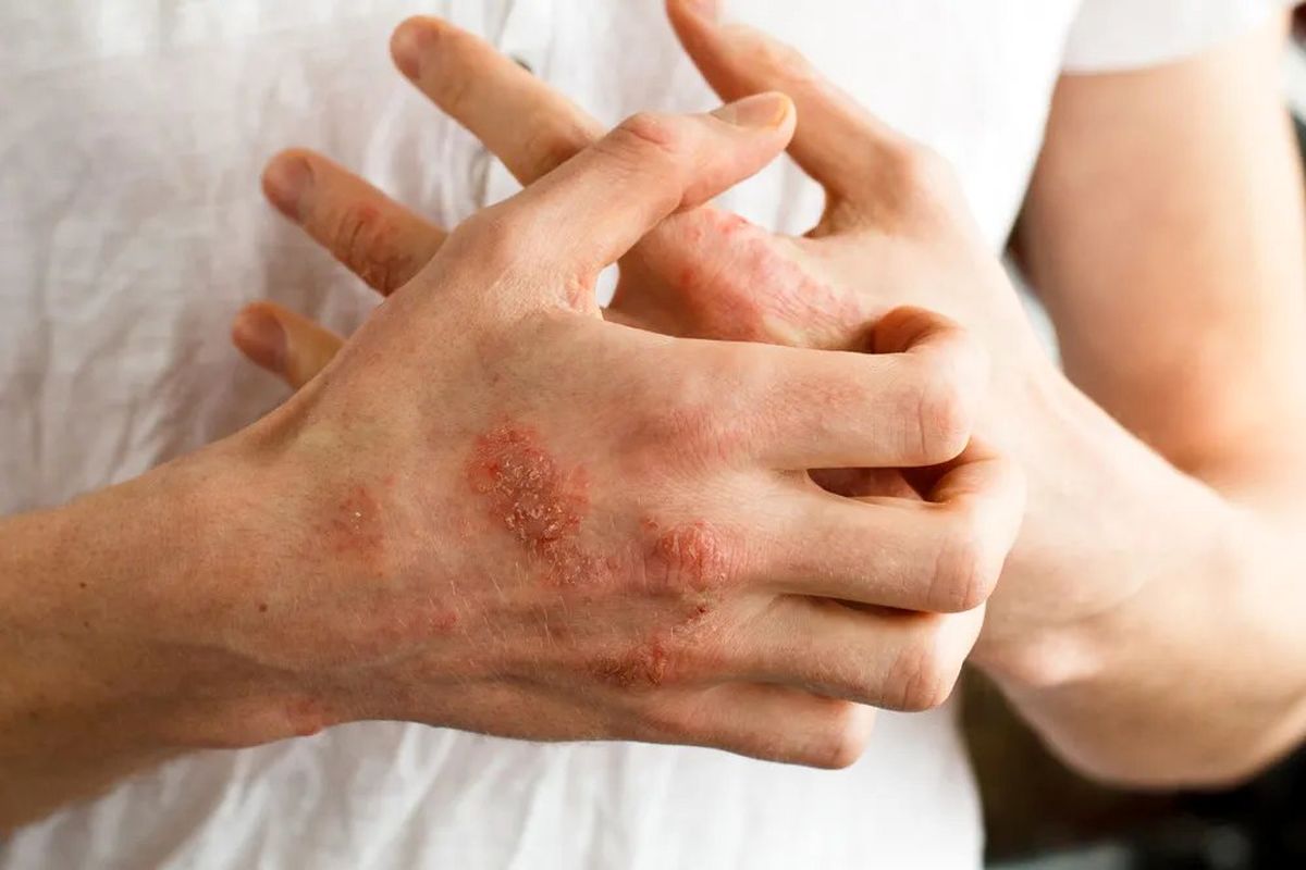 علائم حیاتی اگزما: چگونه بفهمیم که اگزما داریم؟