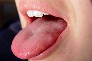 سوزش زبان نشانه چه بیماری هایی است؟