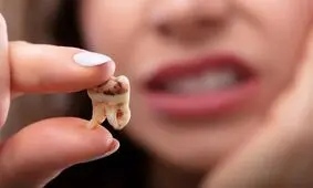 برای جلوگیری از پوسیده شدن دندان این مواد غذایی را کمتر بخورید