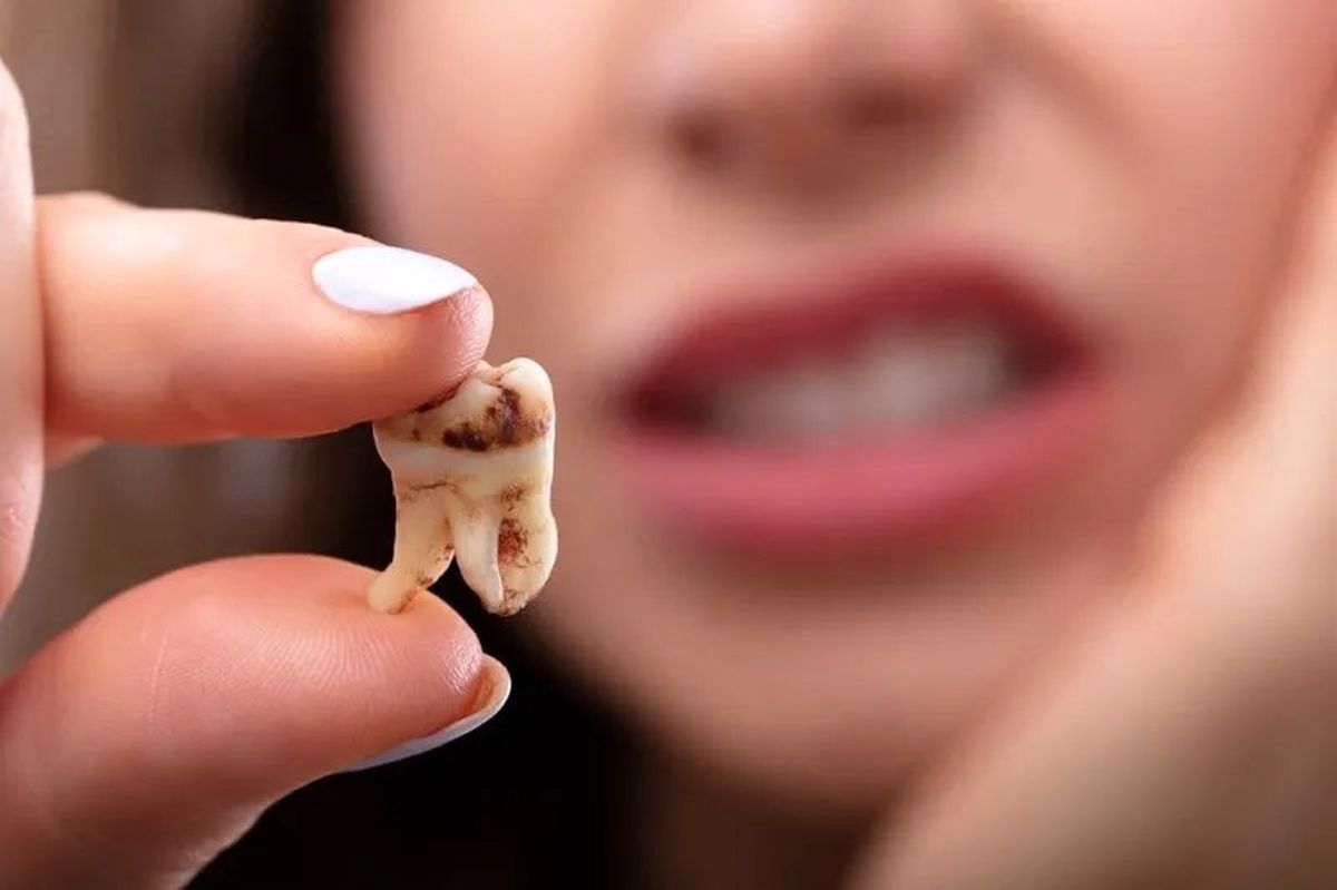 برای جلوگیری از پوسیده شدن دندان این مواد غذایی را کمتر بخورید