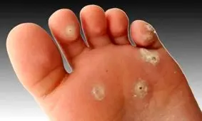 میخچه پا چیست | درمان میخچه پا در منزل