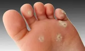 میخچه پا چیست | درمان میخچه پا در منزل