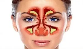 غلبه بر عفونت سینوس: ترفندهای ساده و موثر بدون نیاز به دارو/ اینفوگرافی